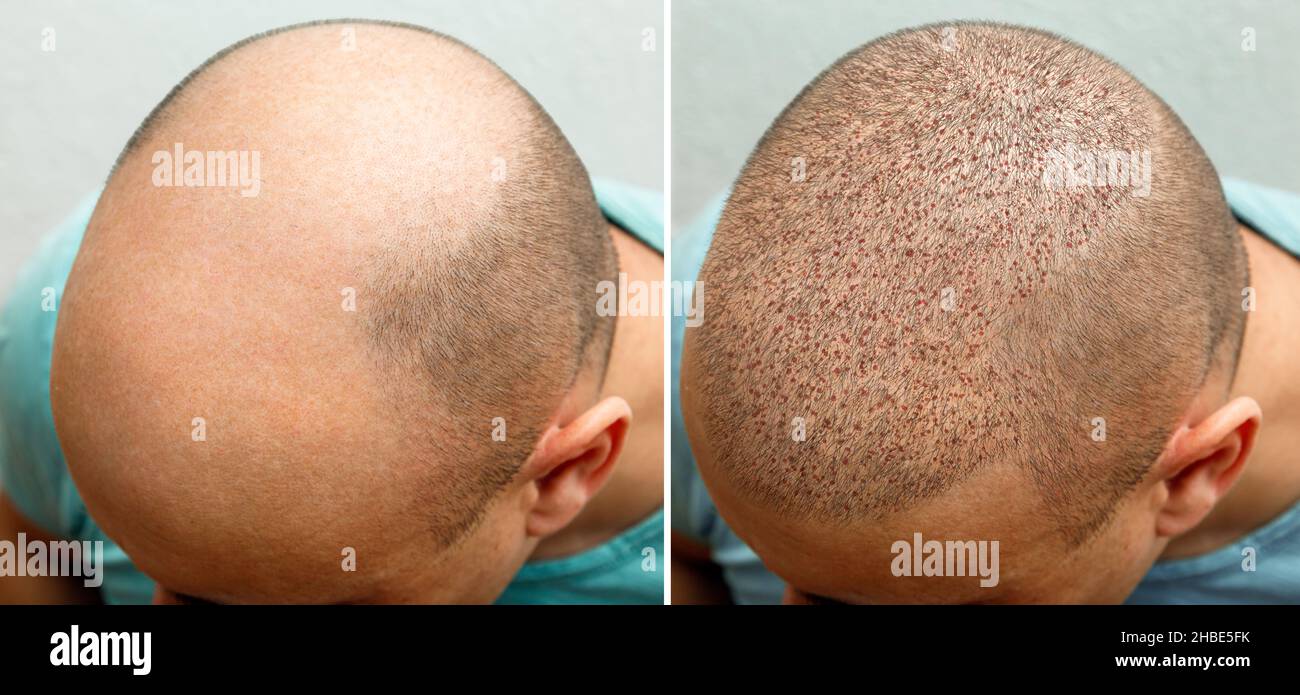 The head of a balding man before and after hair transplant surgery. A man losing his hair has become shaggy. An advertising poster for a hair Stock Photo