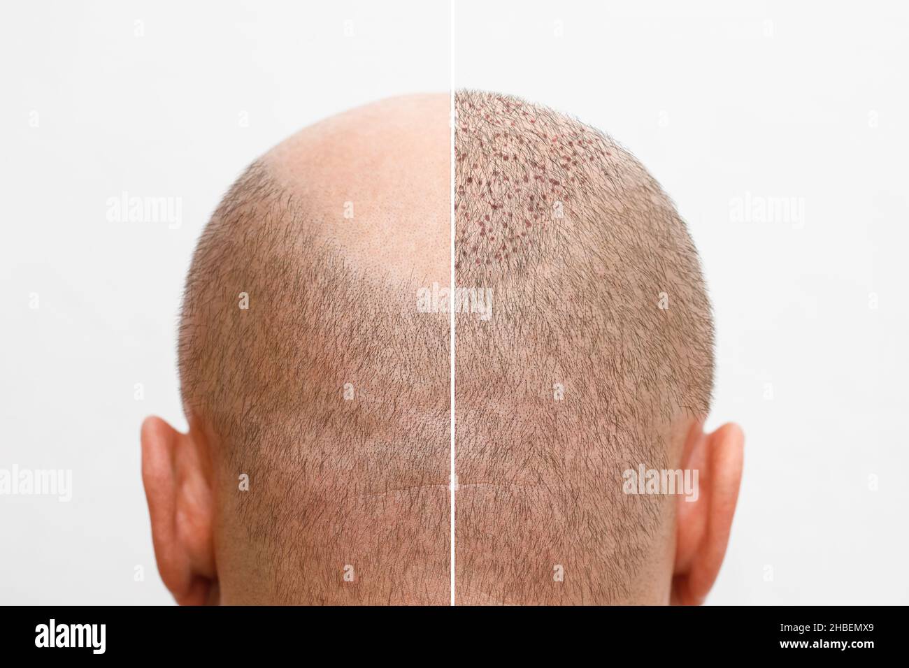 The head of a balding man before and after hair transplant surgery. A man losing his hair has become shaggy. An advertising poster for a hair Stock Photo