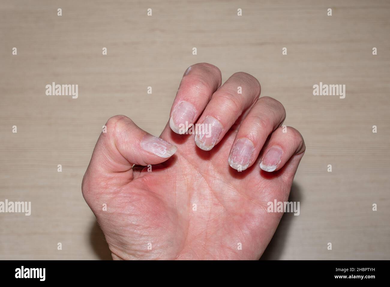 Damaged fingernail hi-res stock photography and images - Alamy