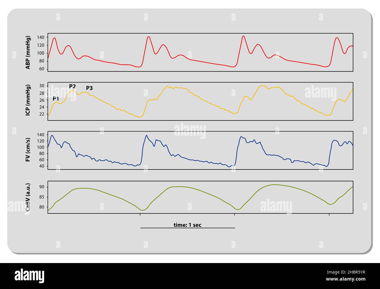 Intracranial Pressure Monitoring ICP waveform, 3d render, 2d graphic, illustration Stock Photo