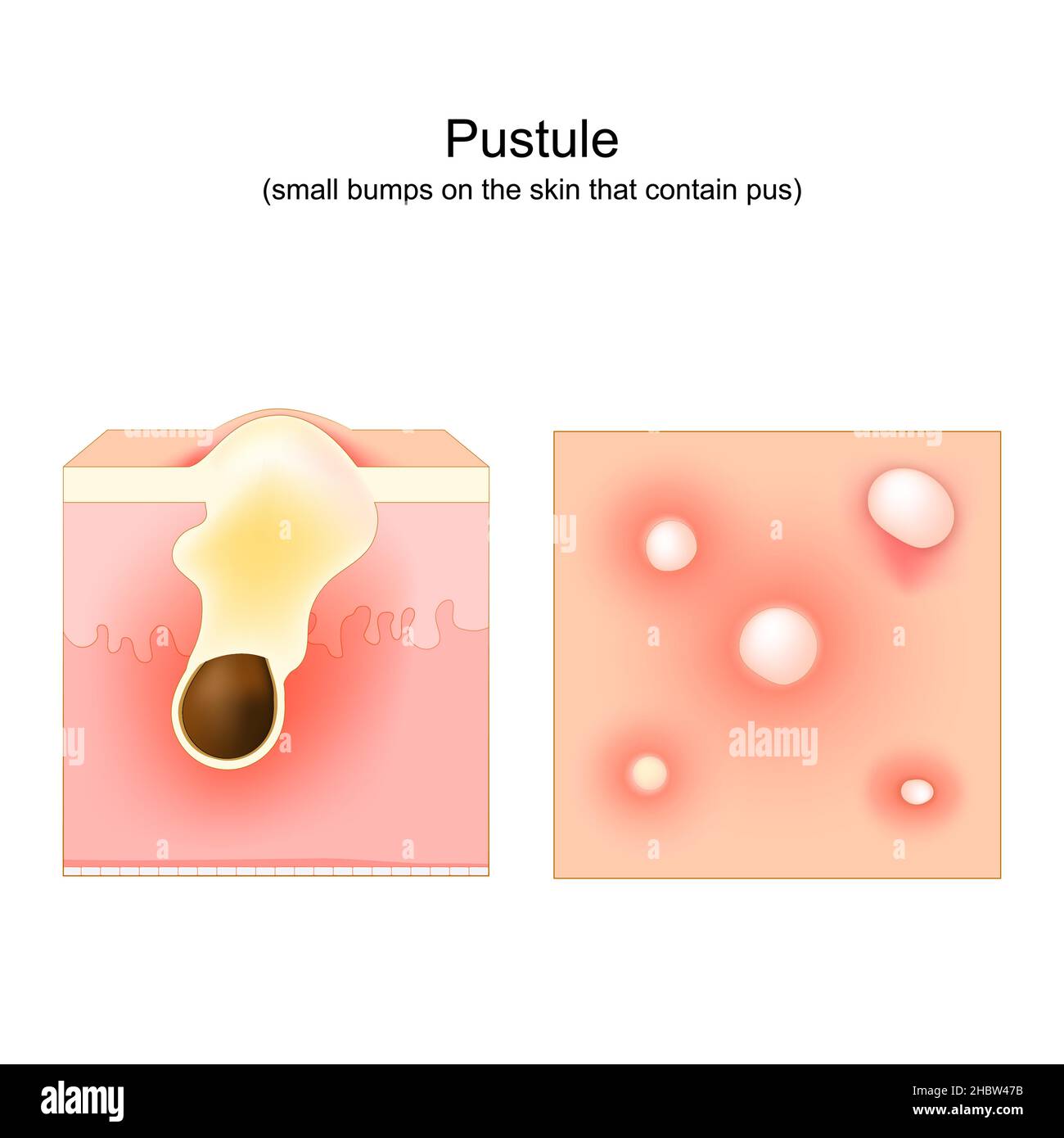 Acne. Pustule is small bump on the skin that contain pus. Cross-section of a human skin. Hair follicle with pus. Top view of the skin with pimples Stock Vector