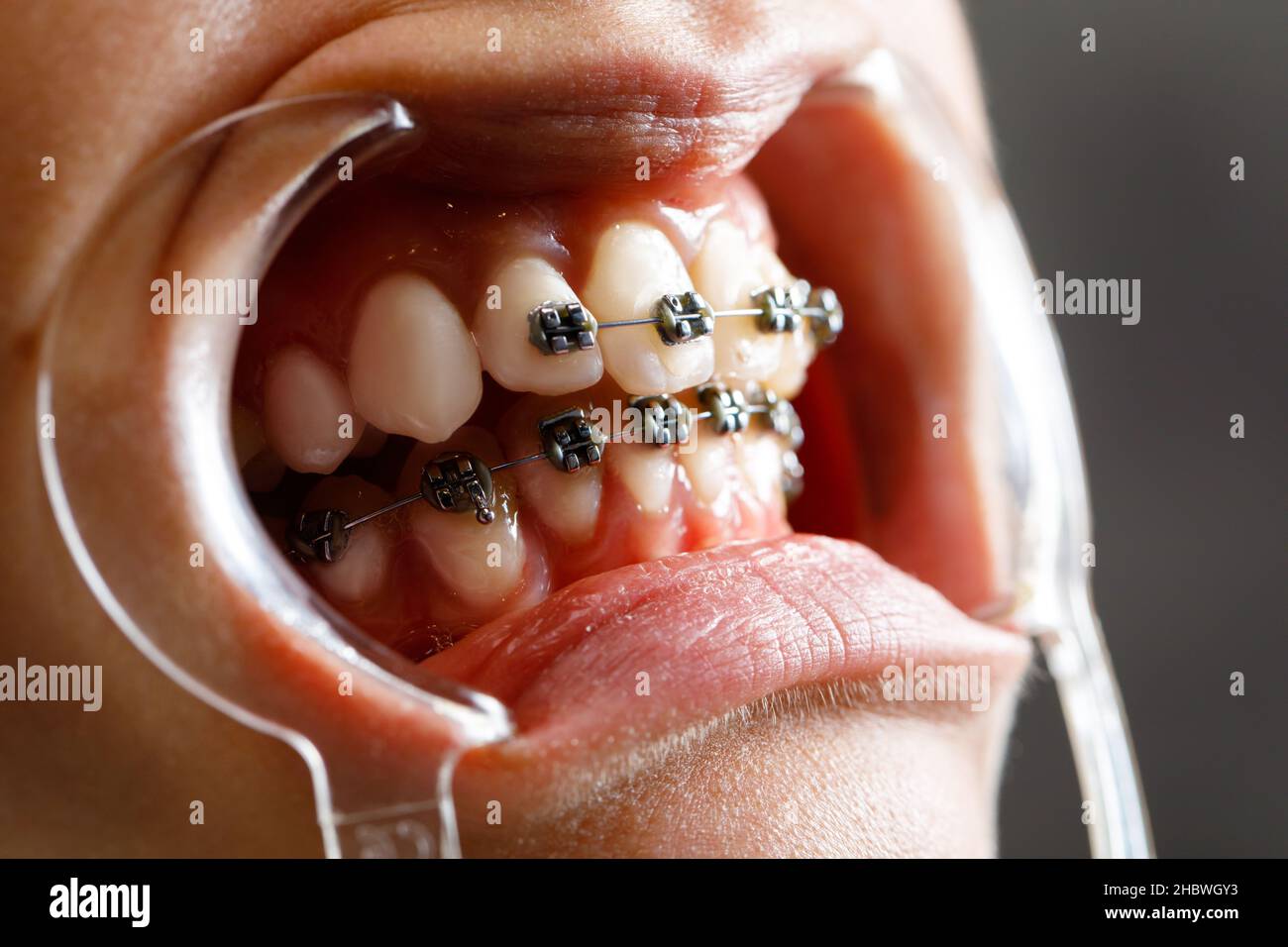 A young woman with metal braces is being examined by an orthodontist