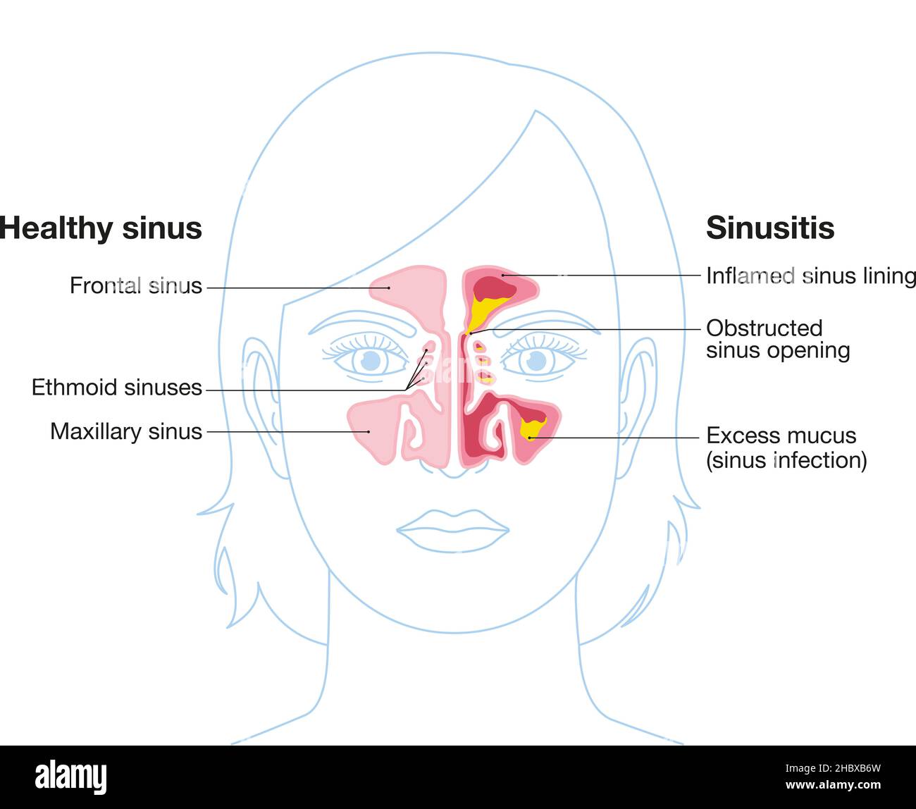 Vector illustration showing healthy sinus and sinusitis with inflamed lining, obstructed sinus opening, adenoid and excess mucus Stock Photo