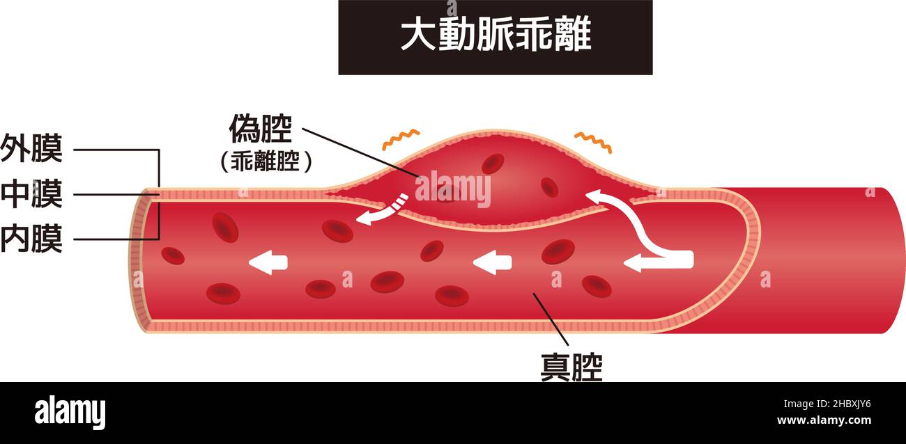 Vector Illustration Of Aortic Dissection Japanese Monitoring Ct Artery The Best Porn Website