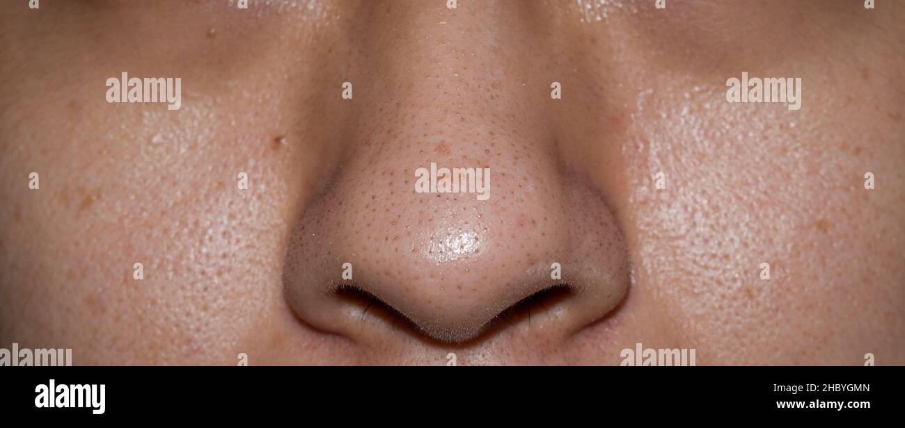 Blackheads or black heads on nose of Asian man. They are small bumps that appear on skin due to clogged hair follicles. Stock Photo