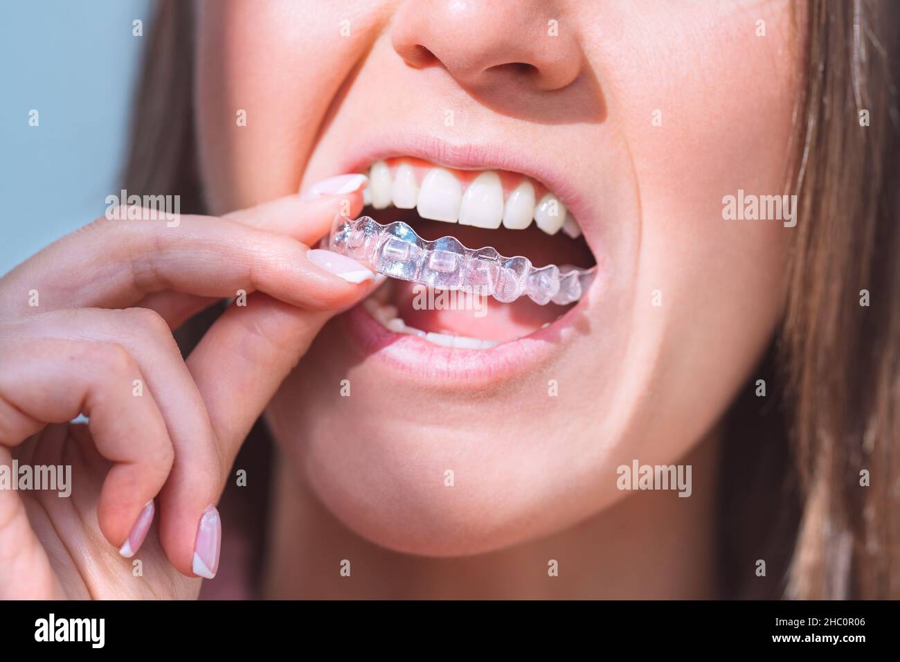 Aligners hi-res stock photography and images - Alamy
