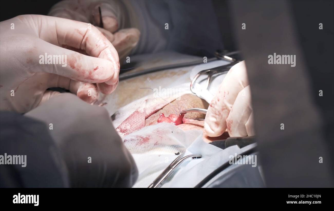 Sewing up the surgical wound with medical tools and catgut. Close up of surgeon hands stitches a wound after the surgery of the male genital system. Stock Photo