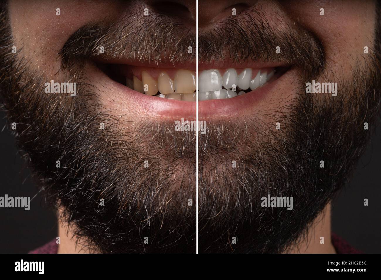 Smiling man before and after teeth whitening procedure, closeup. whitening teeth laser bleach in male man tooth compare before after treatment in Stock Photo