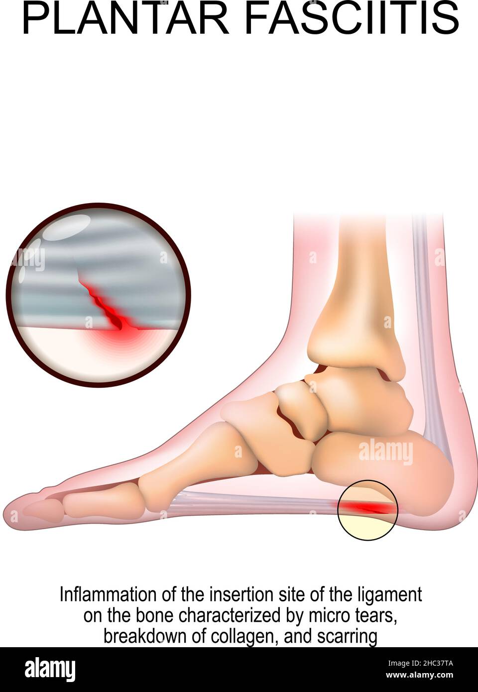 Plantar fasciitis. foot with the symptoms of plantar fasciitis. disorder of the connective tissue which supports the arch of the foot. Stock Vector