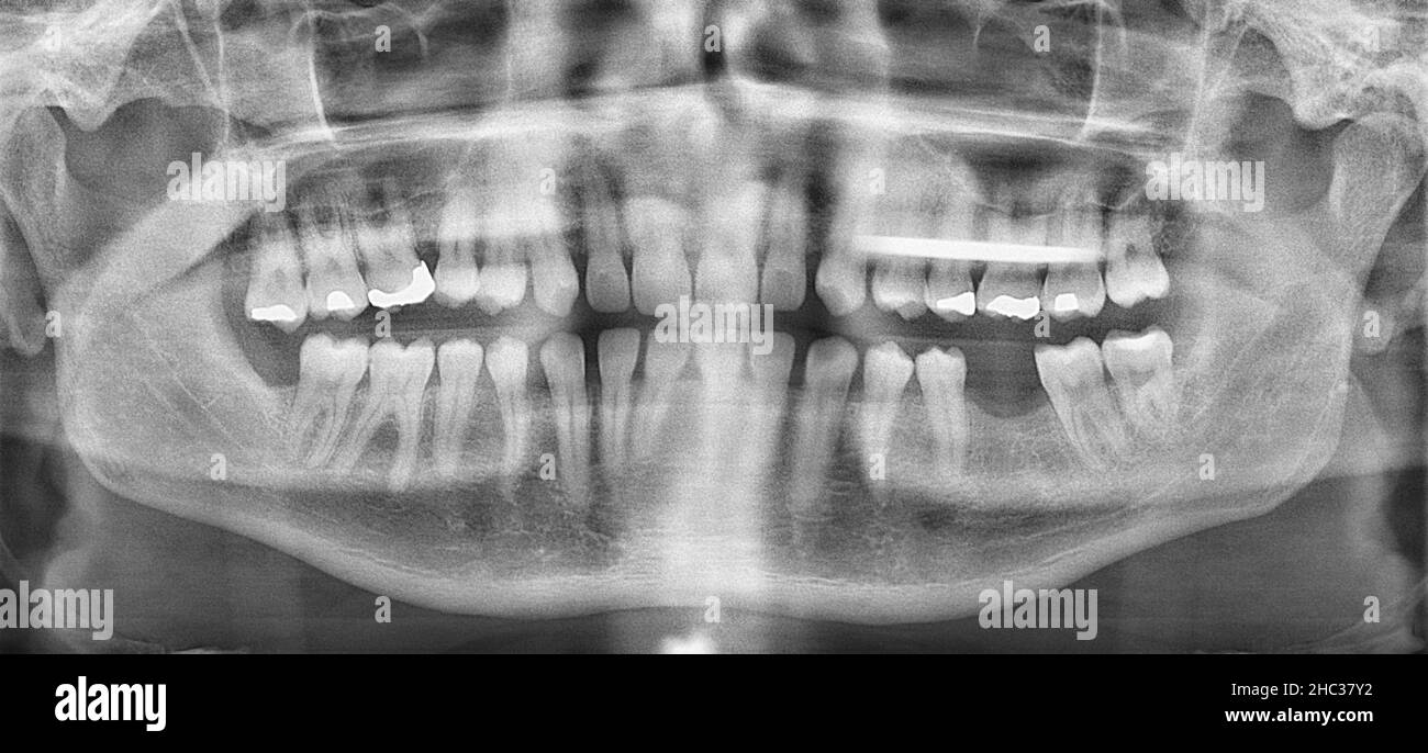 Panoramic dental x-ray with some tooth fillings. Stock Photo