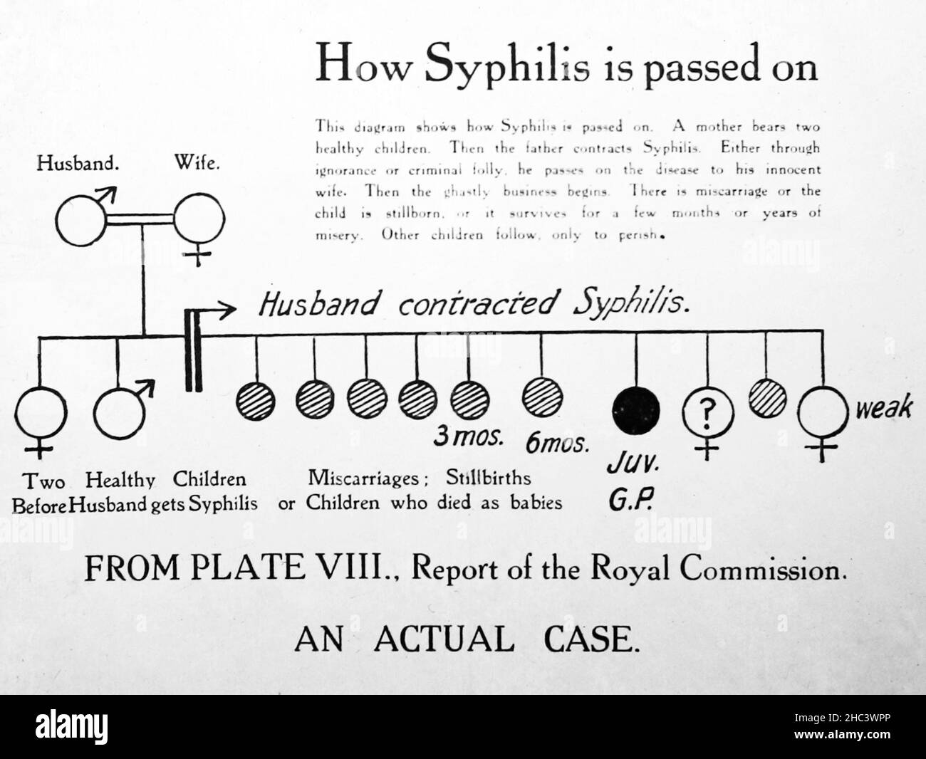 How syphilis is passed on, 1920s projection slide Stock Photo
