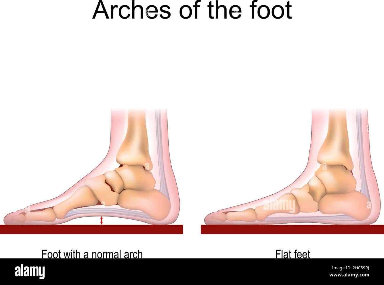 Arches of the foot. Foot with a normal arch and Flat feet. vector poster for medical use Stock Vector