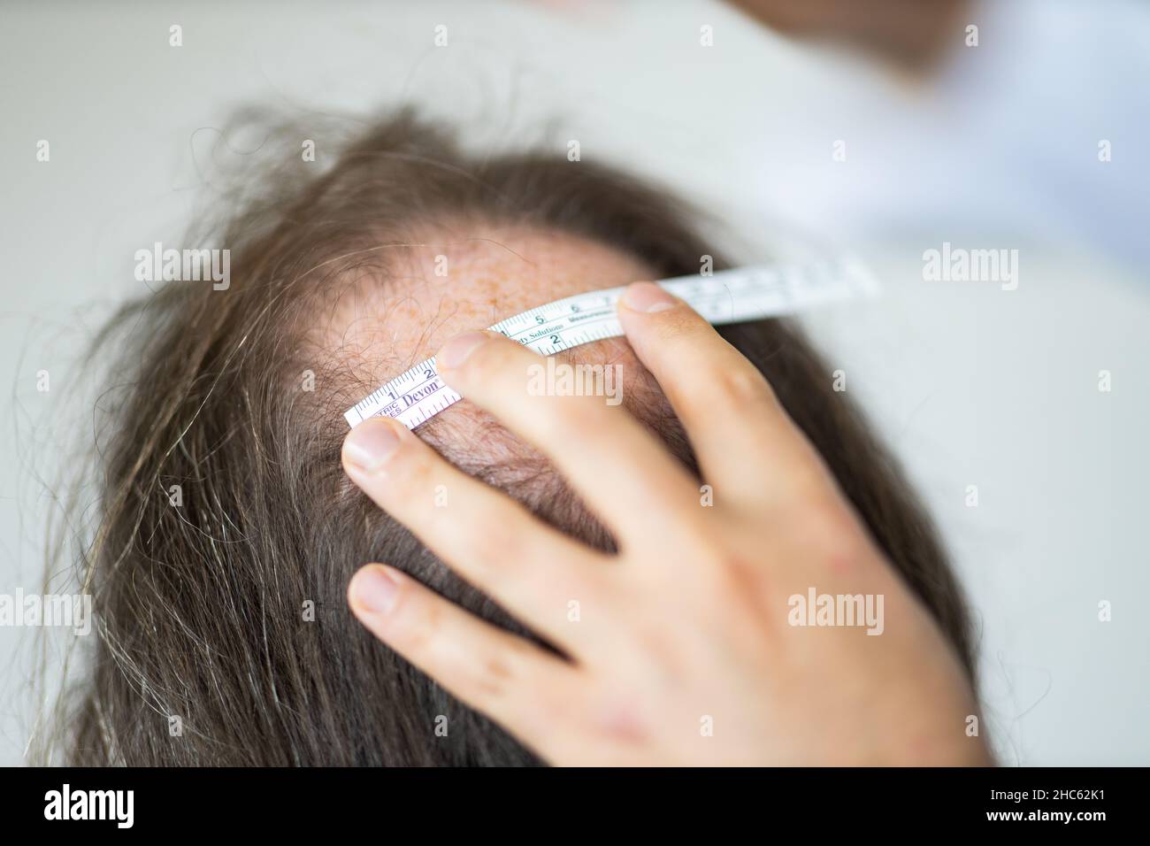 Closeup of woman's hands working for hair transplant preparation on man's head Stock Photo