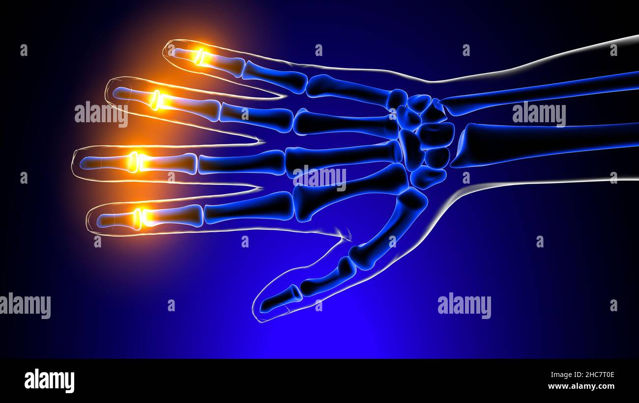 Distal interphalangeal joints pain Anatomy For Medical Concept 3D