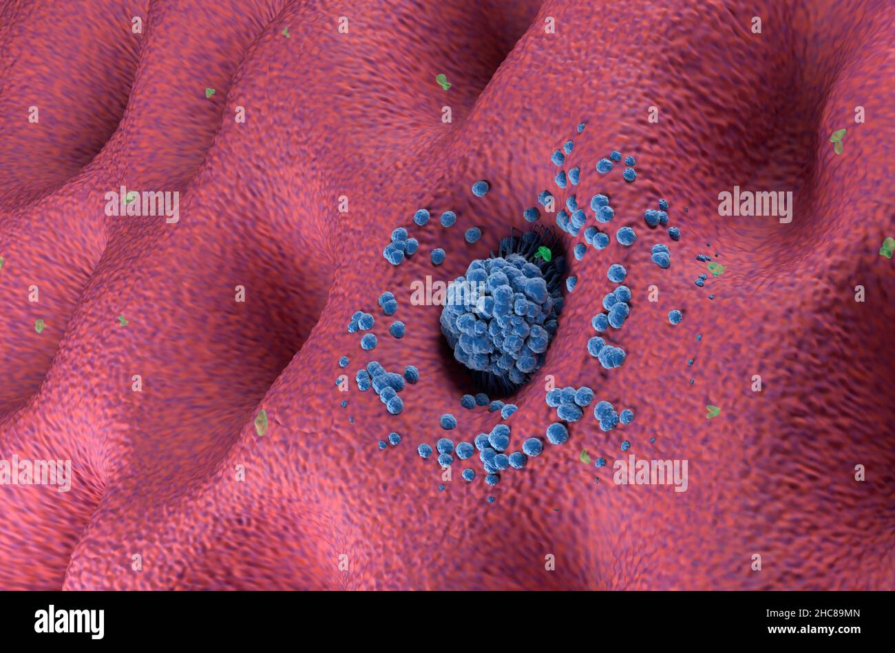 Early stage gastric cancer tumor on the stomach wall angle view 3d illustration Stock Photo