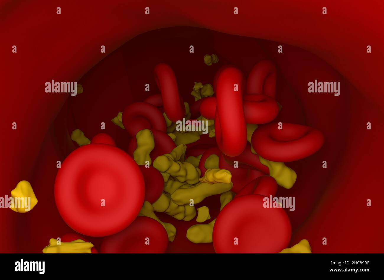 Higher level of cholesterol crystals and red blood cells flowing in ...