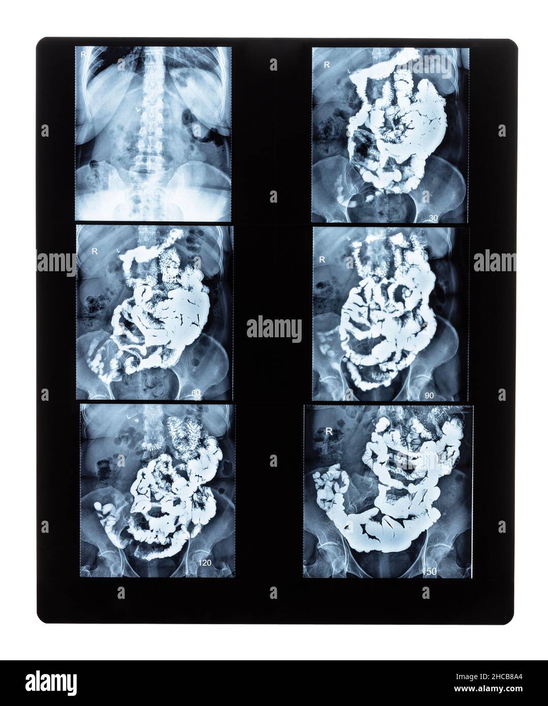 film with set of X-ray radiogram with Barium studies of small bowel isolated on white background Stock Photo