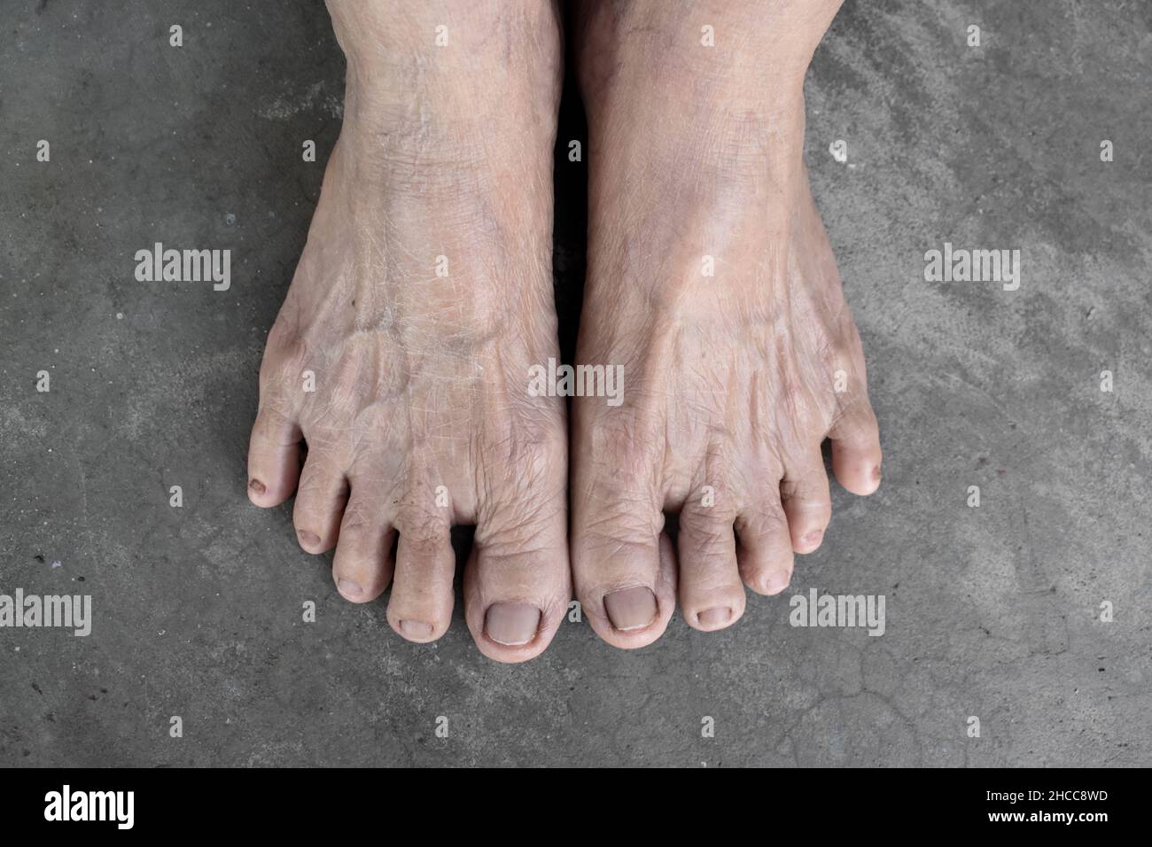 Feet of Asian elder woman. Concept of foot and toes health, and thin skin. Isolated on concrete background. Stock Photo
