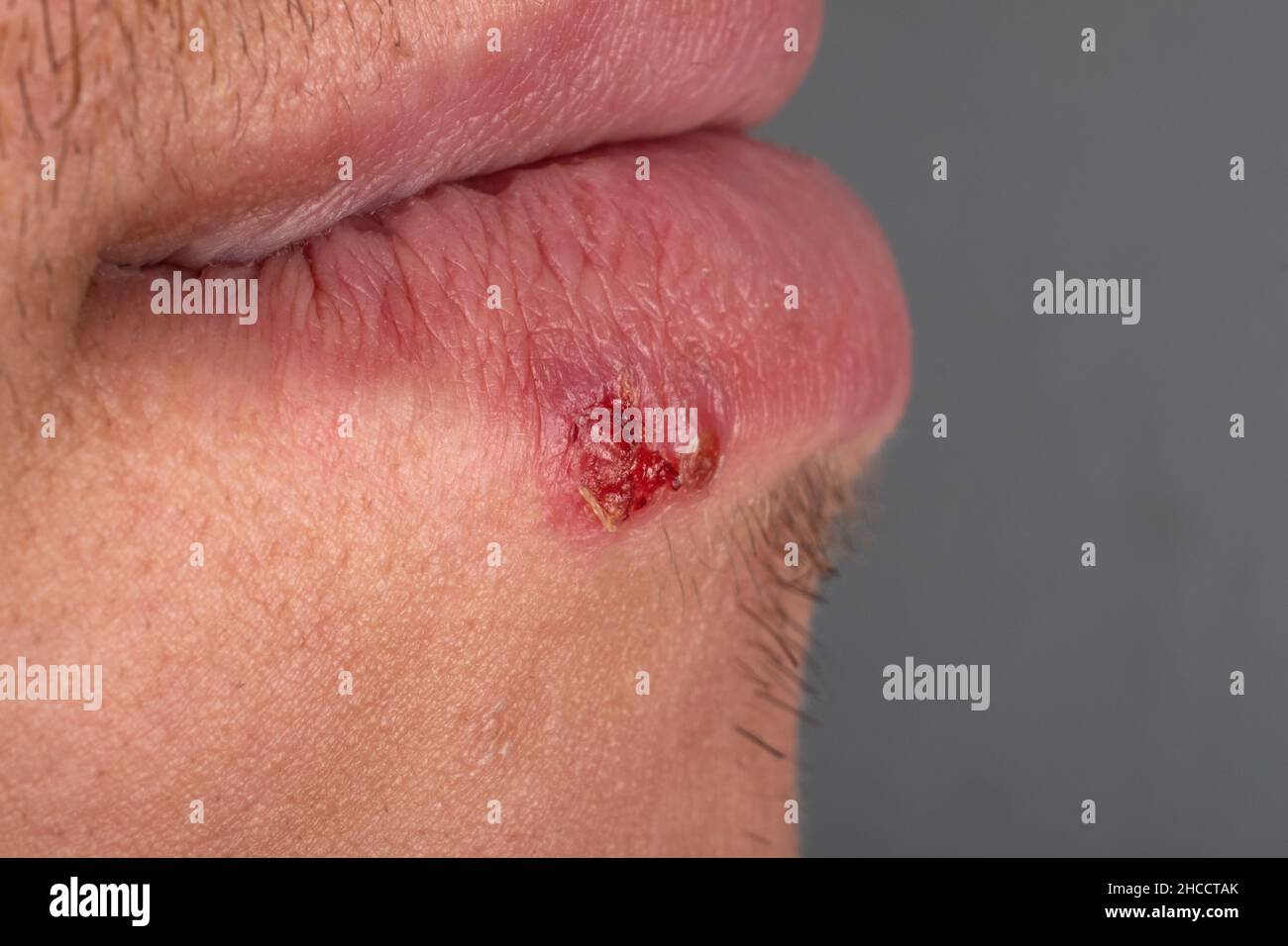 herpes in lips is a viral skin disease closeup Stock Photo
