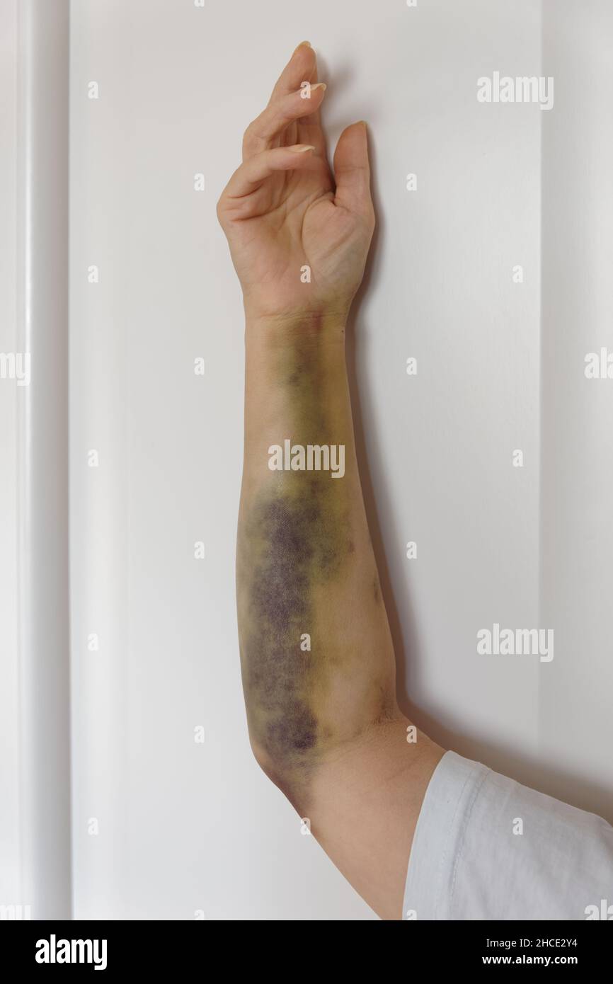 Severe arm bruising after coronary angioplasty in female patient Stock Photo