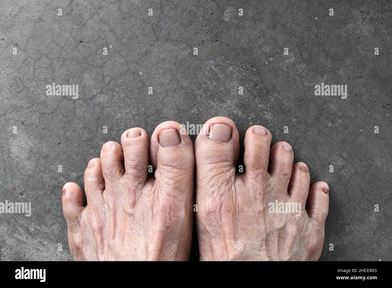 Feet of Asian elder woman. Concept of foot and toes health, and thin skin. Isolated on concrete background. Stock Photo