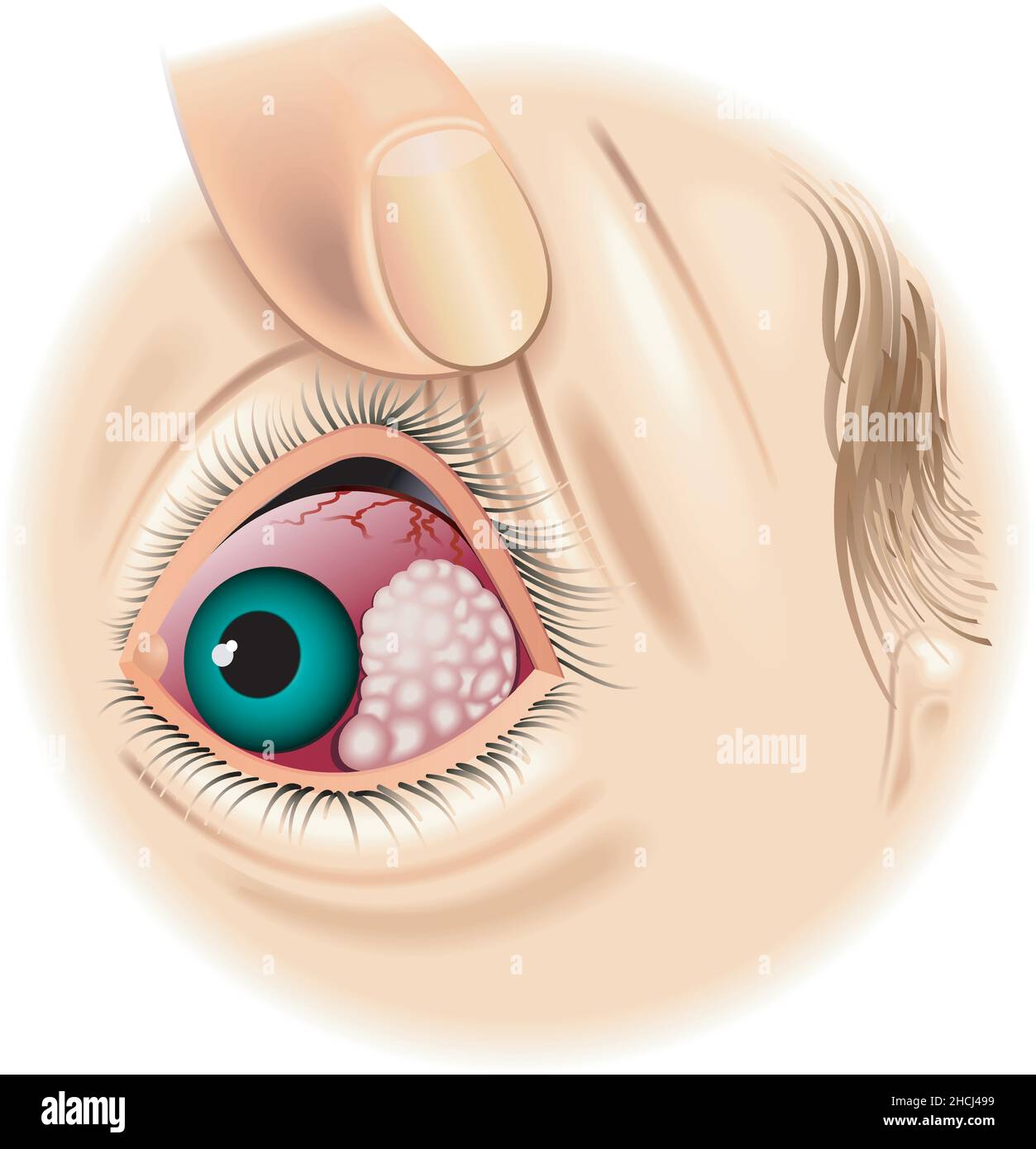 Medical illustration of an eye with tumor. Stock Vector