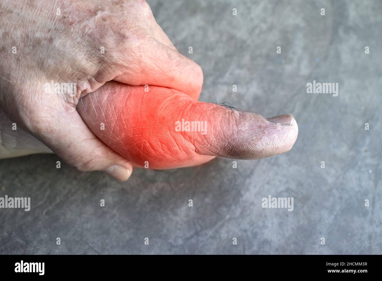 Inflammation of base of big toe. Concept of foot joint pain, arthritis, stumble, hyperuricema or gout. Stock Photo
