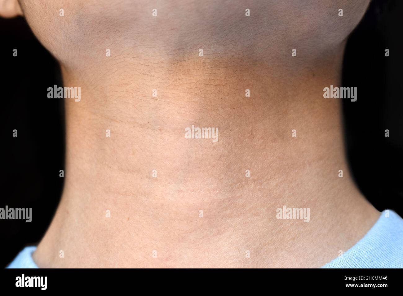Aging skin folds or skin creases or wrinkles at neck of Southeast Asian, Chinese young man. Left lateral view. Stock Photo