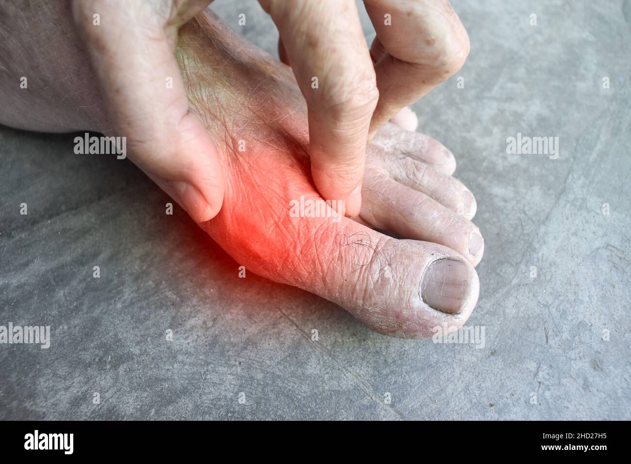 Inflammation of Asian old man’s foot. Concept of foot joint pain, arthritis, stumble, hyperuricema or gout. Stock Photo