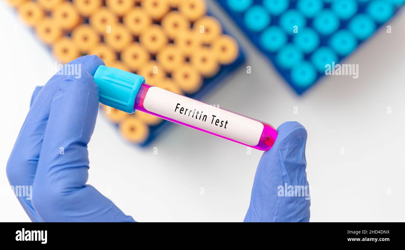 Ferritin test result with blood sample in test tube on doctor hand in