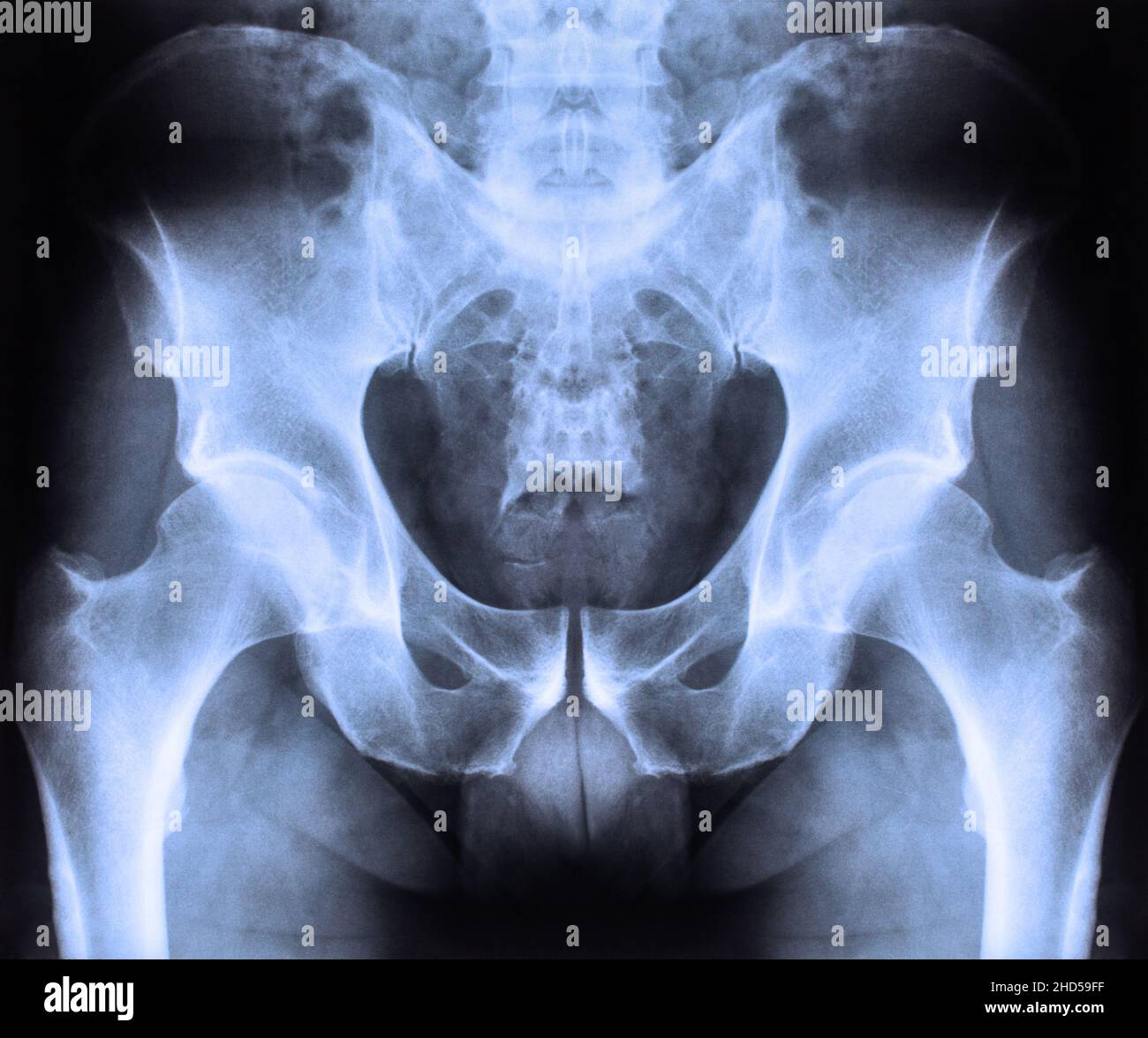 An x-ray of the human spine and pelvis against a dark backgrou Stock ...