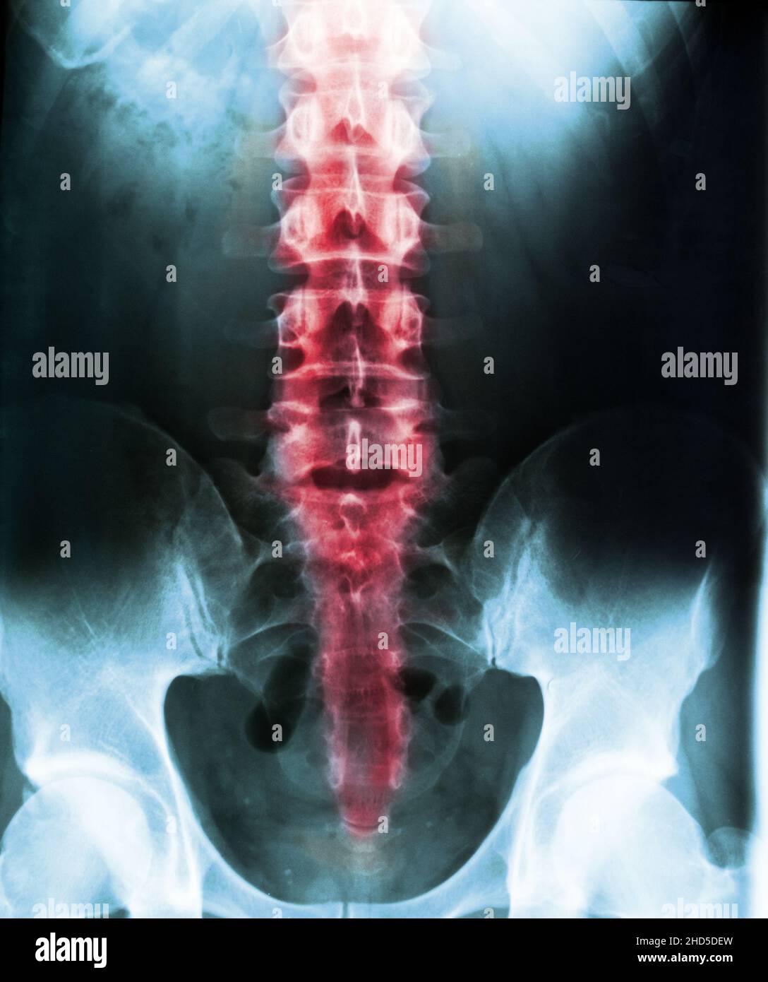 An X-ray of the human spine and pelvis against a dark background Stock ...