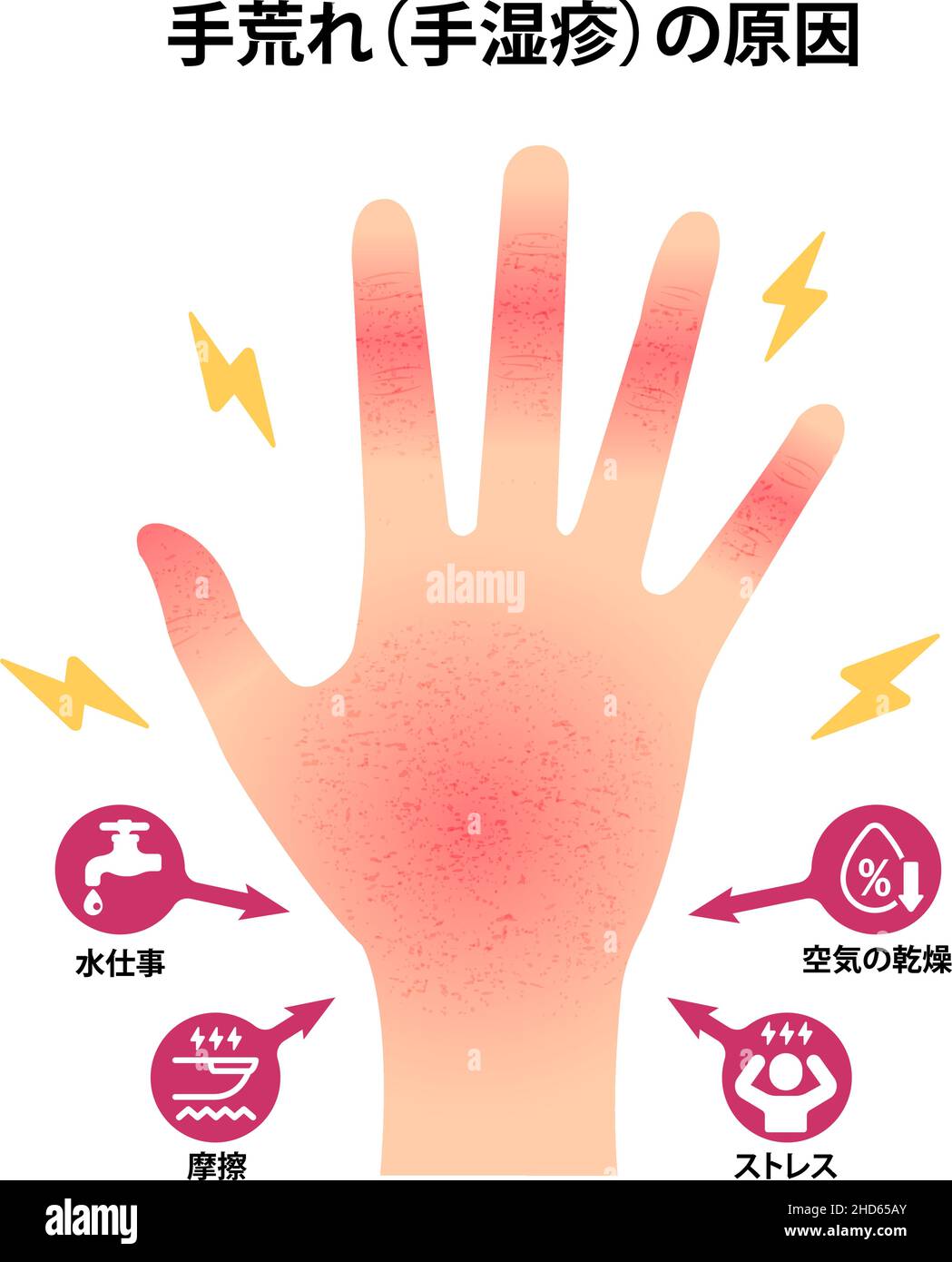 Causes of dry and rough hands ( chapped hands ) vector illustration