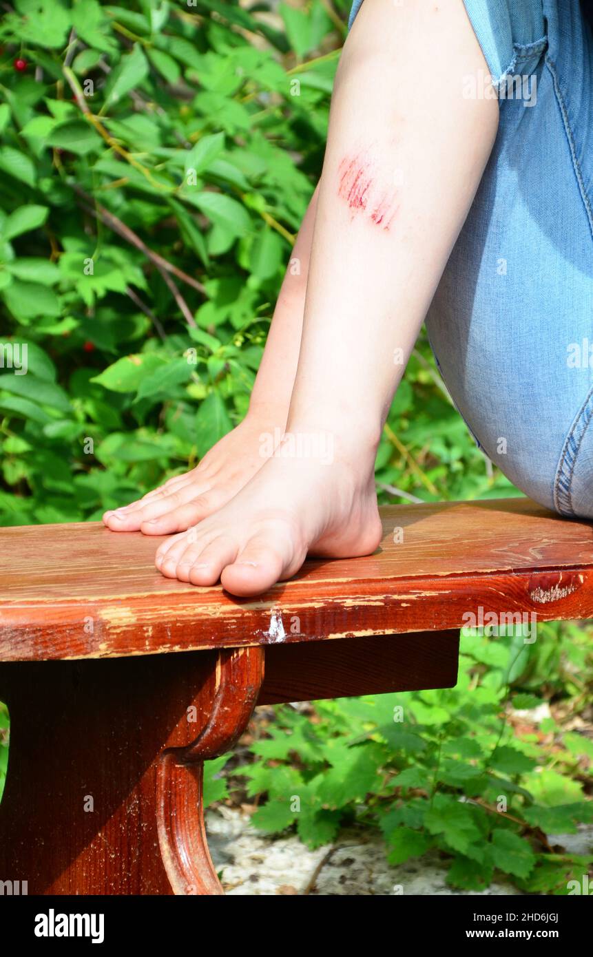 Closeup of injured young kid's knee after he fell down on pavement, the