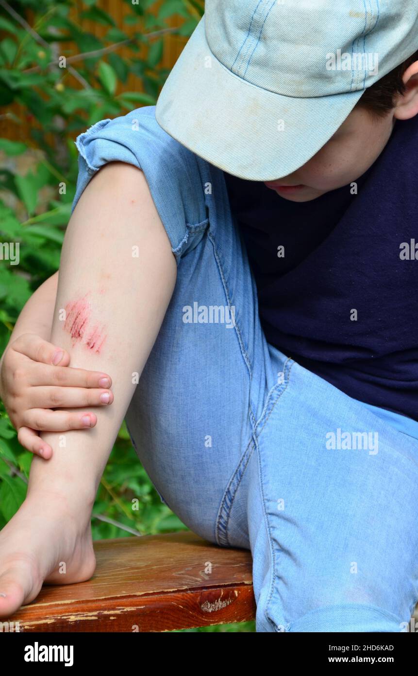 Closeup of injured young kid's knee after he fell down on pavement, the