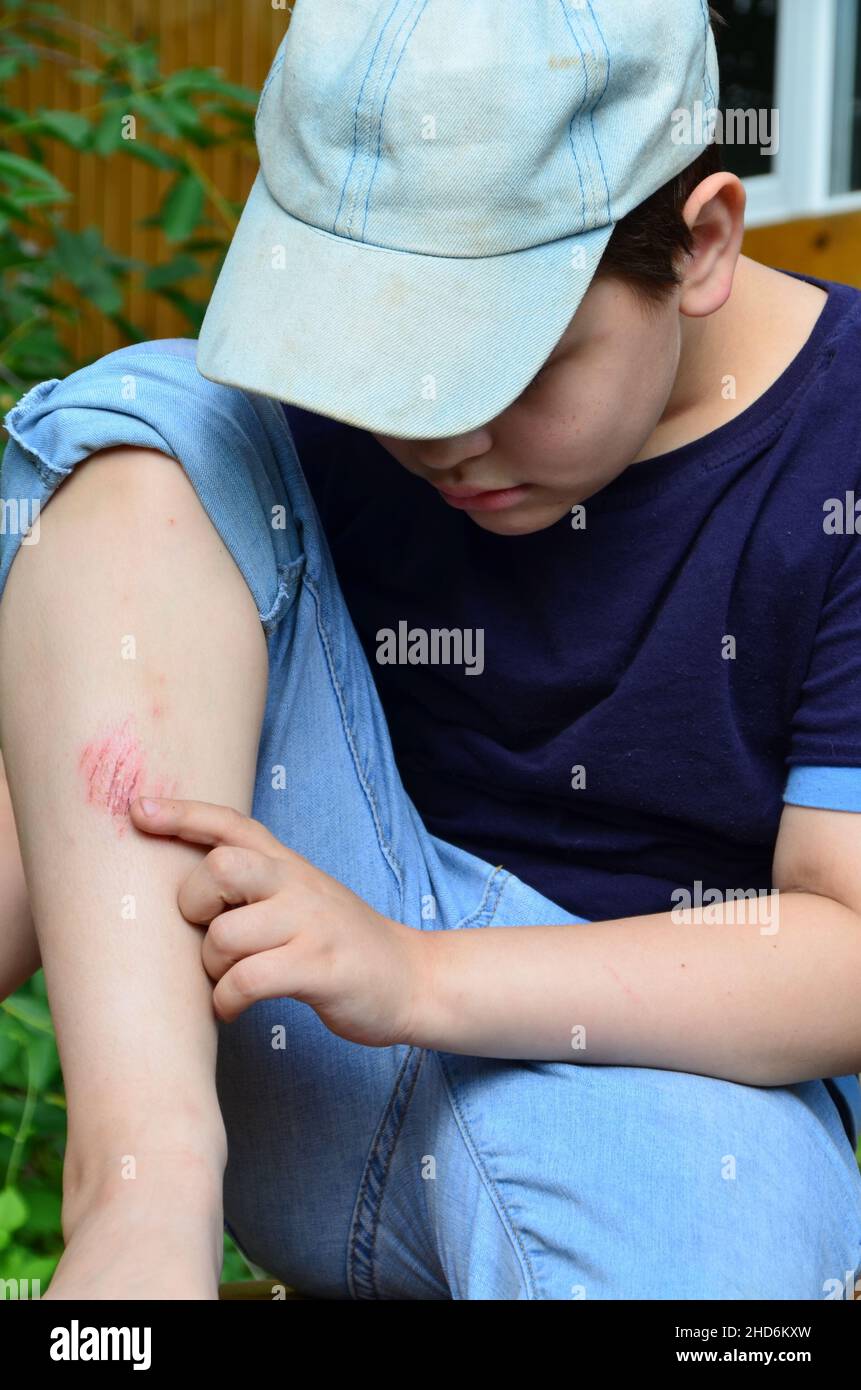 Closeup of injured young kid's knee after he fell down on pavement, the