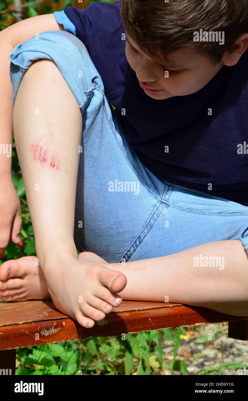 Closeup of injured young kid's knee after he fell down on pavement, the