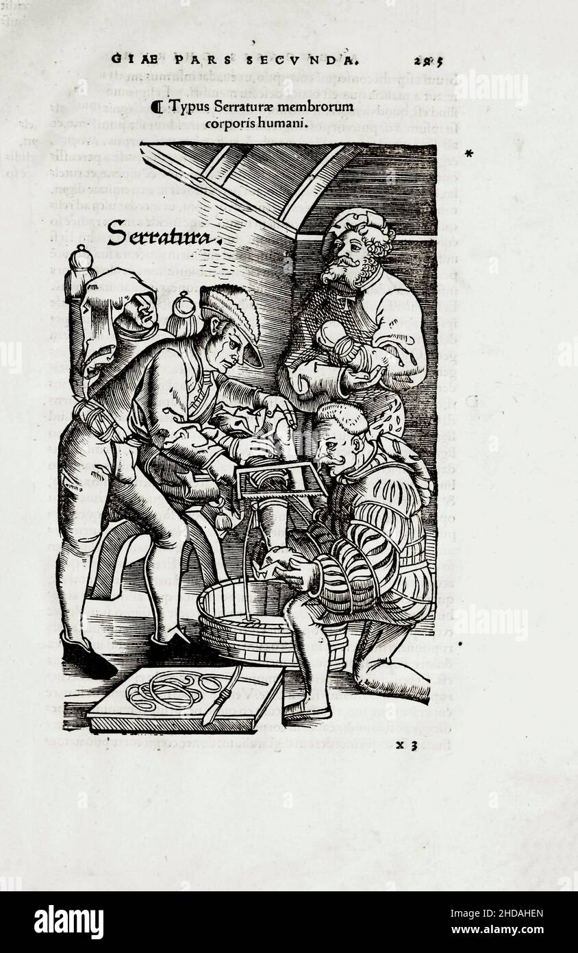 The 16th century illustration of surgery and surgical operations in the Middle Ages: leg amputation. From the medieval books by Octavius Horatianus an Stock Photo