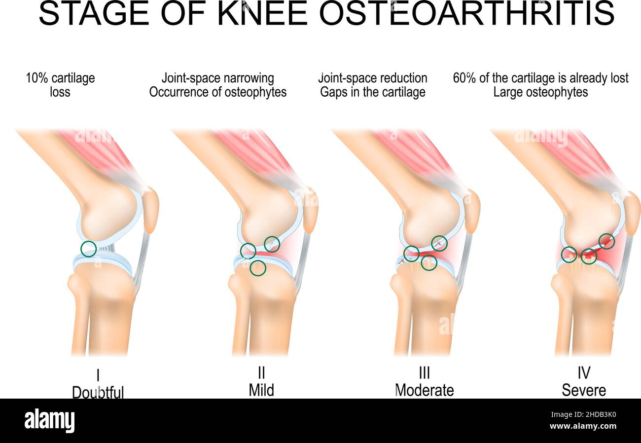 knee Osteoarthritis. Stages of OA. Kellgren and Lawrence criteria for assessment stage of osteoarthritis. Stock Vector