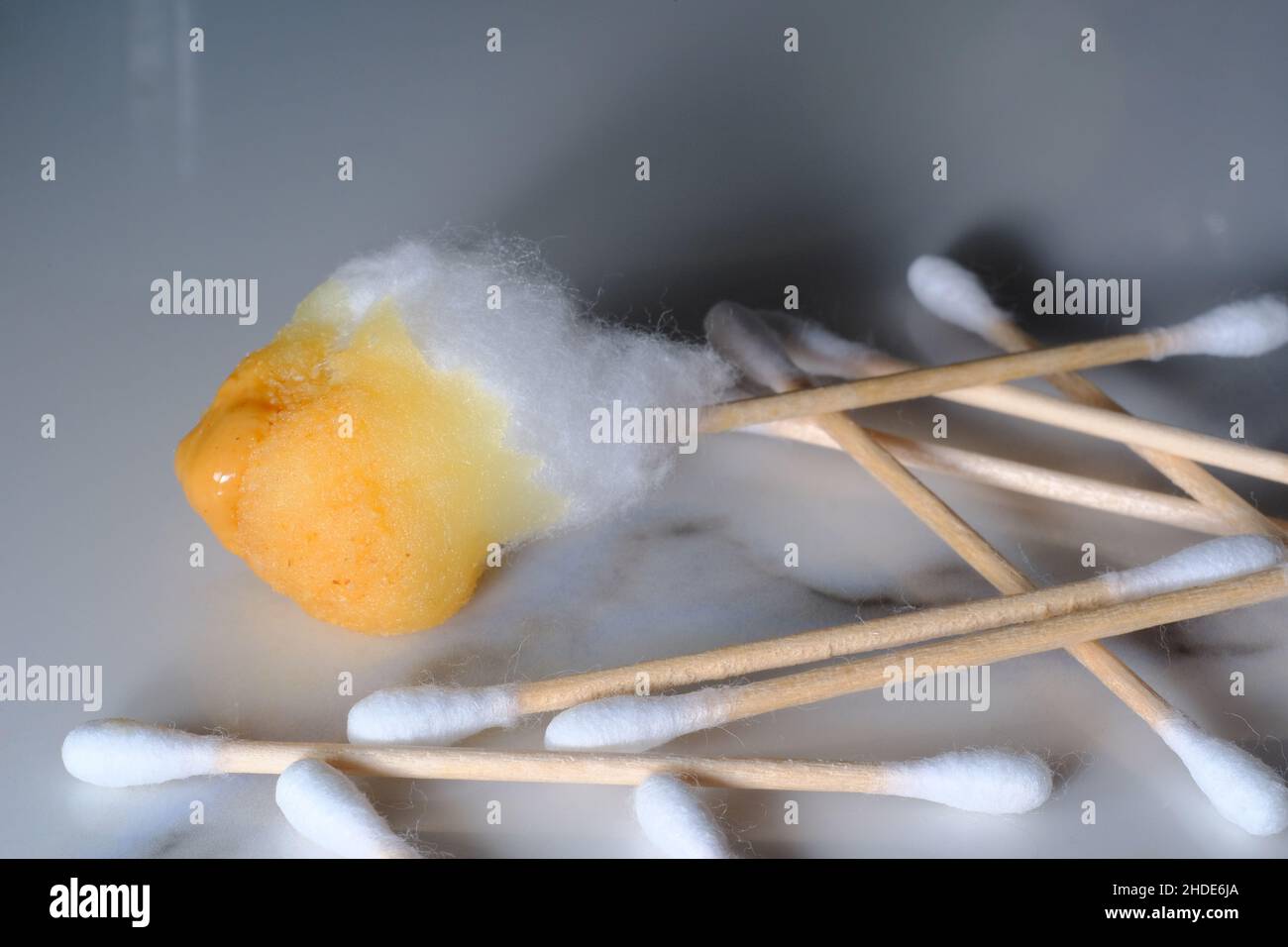 Cleaning extreme amount of ear wax using cotton swabs Stock Photo