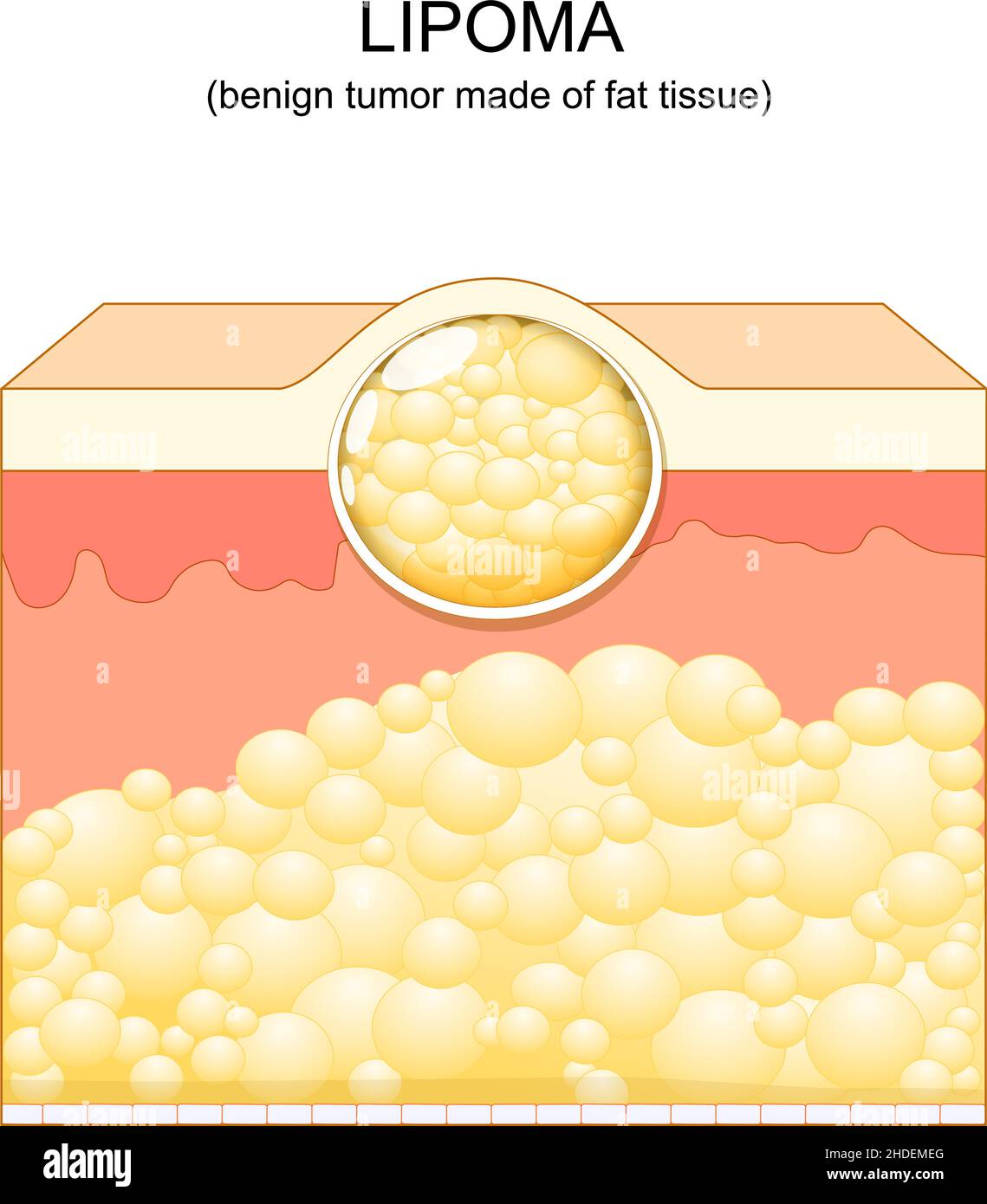 Lipoma. adipose tumors located into the subcutaneous tissues in the skin. Vector illustration. Skin layers Stock Vector
