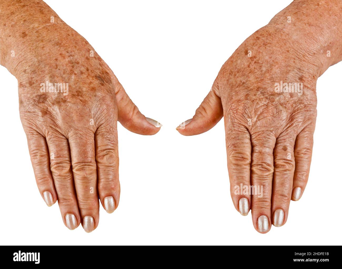 Hands Skin Age Spots Hand Skins Stock Photo Alamy