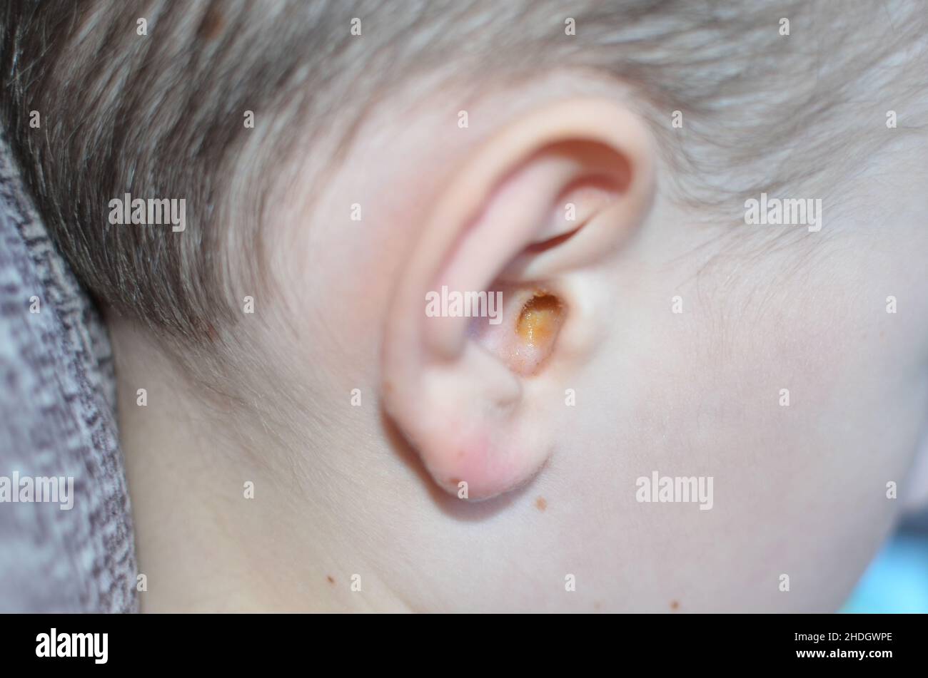 dirty ear with yellow gray in a fair-skinned boy Stock Photo