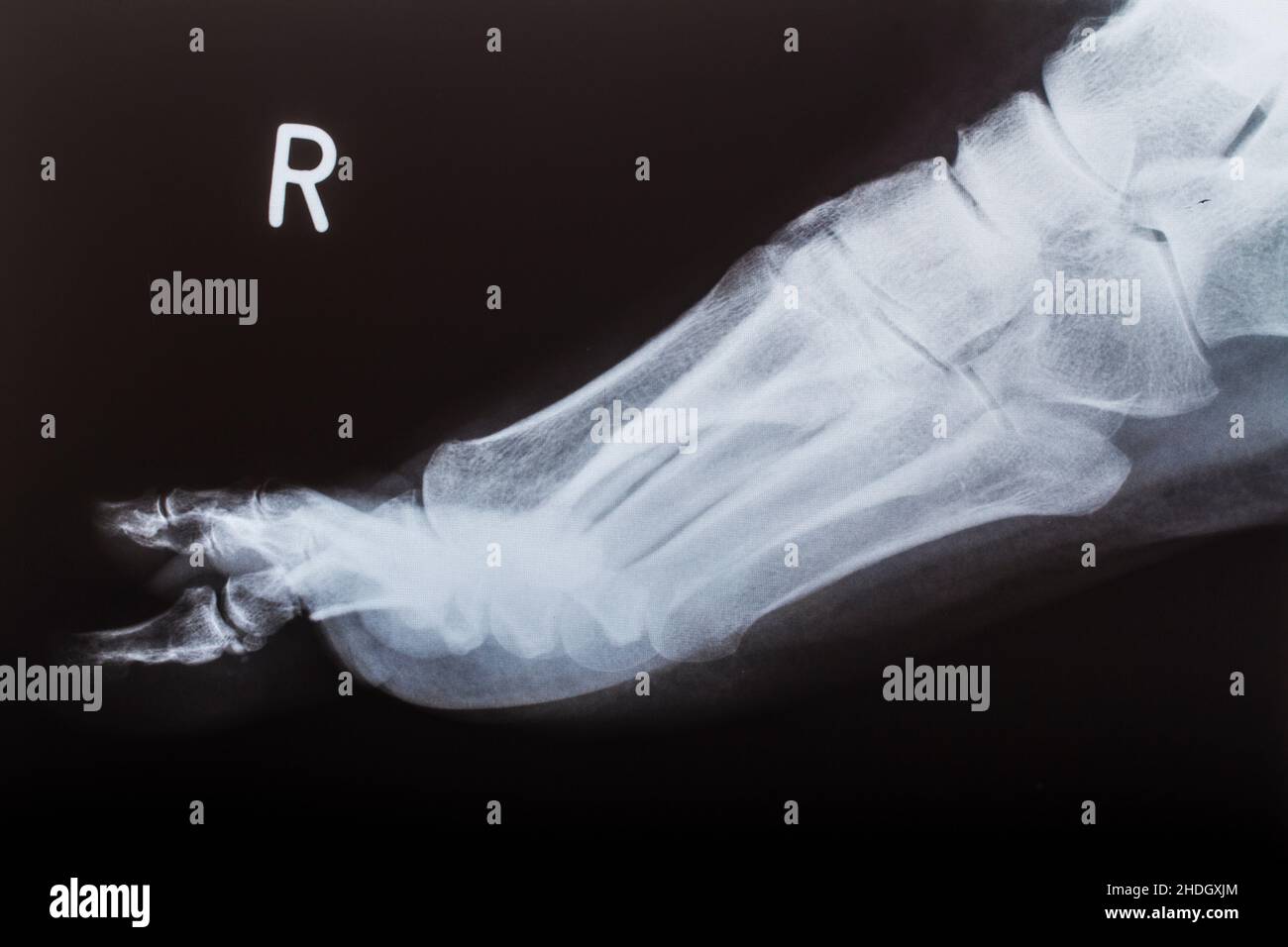 x-ray image, ankle, radiology, x-rays, xray, xrays, ankles Stock Photo ...