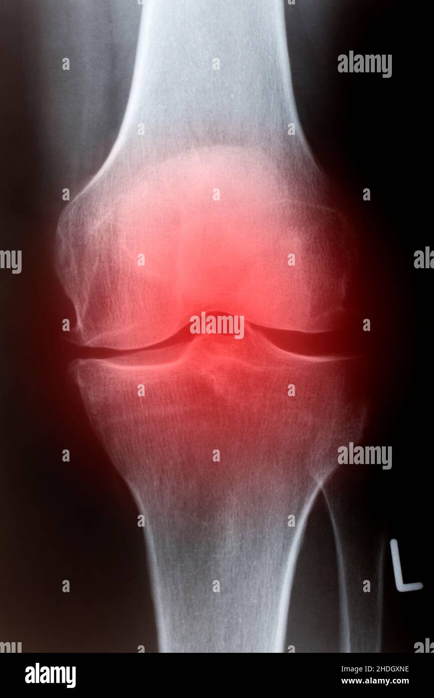 pain, xray image, knee, knee joint, pains, radiology, xrays, xray