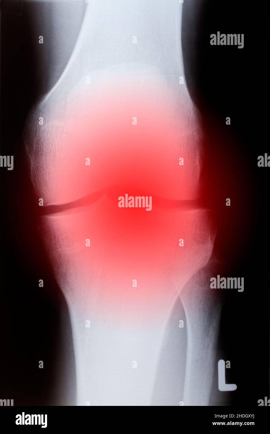 xray image, knee joint, arthritis, radiology, xrays, xray, xrays, knee joints Stock Photo Alamy