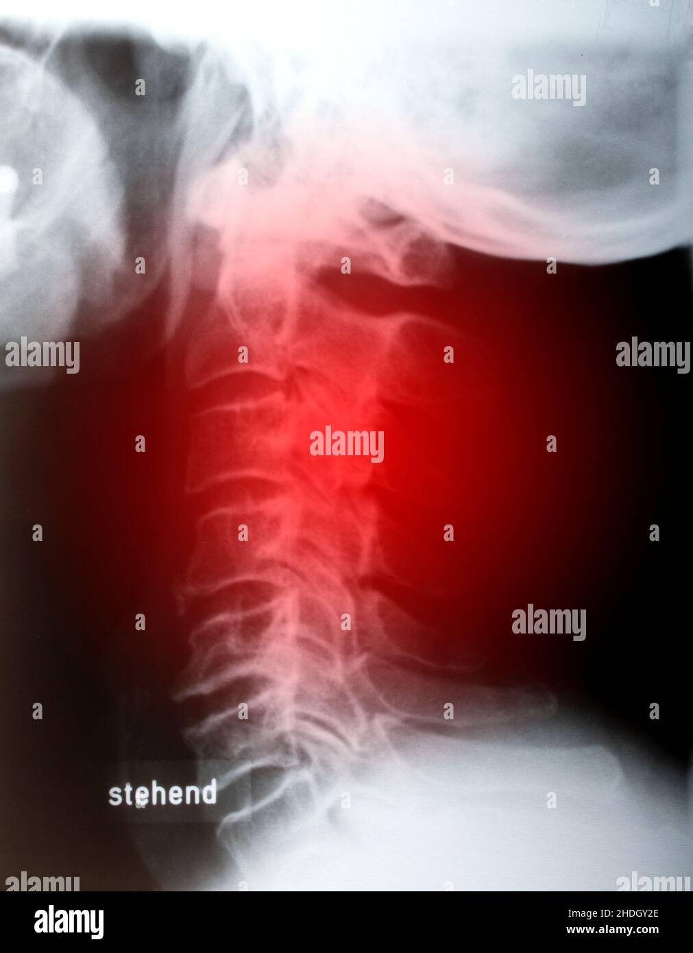 pain, xray image, injury, human spine, cervical spine, pains
