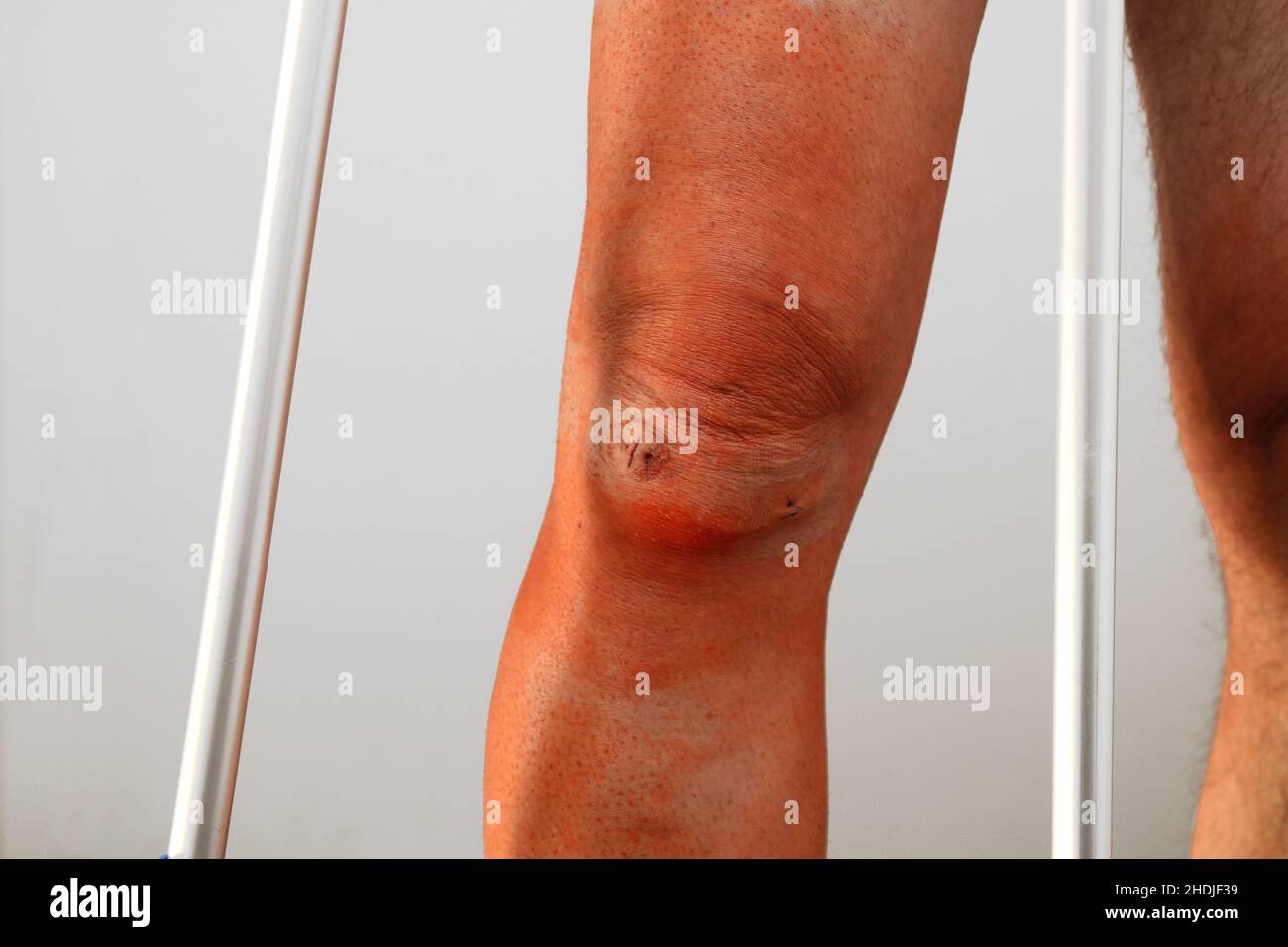 wound, patella, wounds, knee, patellas Stock Photo