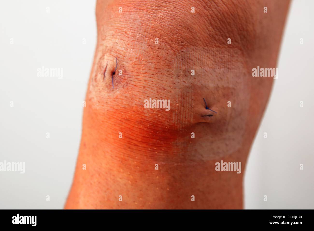 wound, patella, wounds, knee, patellas Stock Photo