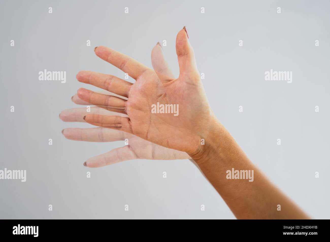 Person Hand With Dystonia. Degenerative Aging Movement Stock Photo Alamy